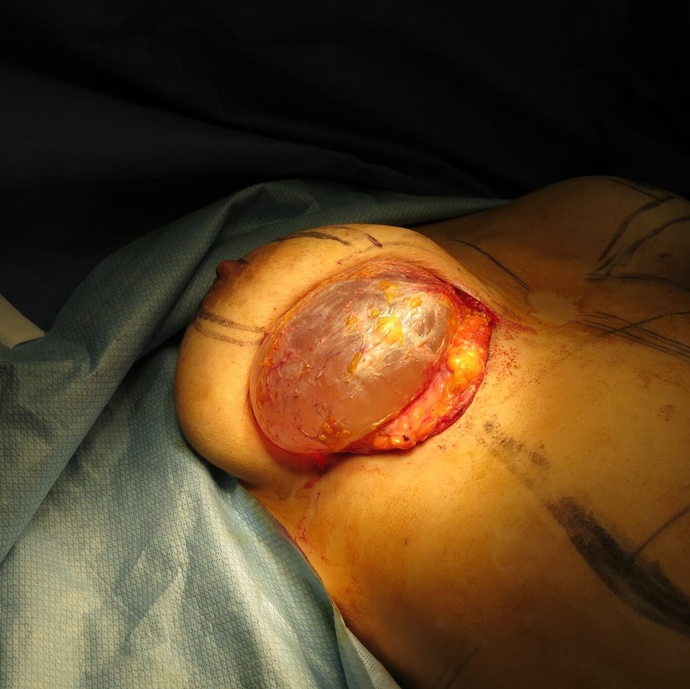 Saline implant